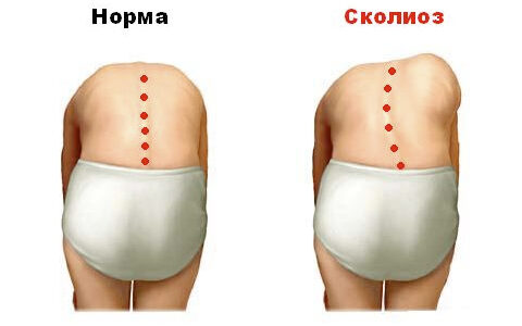 Комплекс упражнений при сколиозе позвоночника