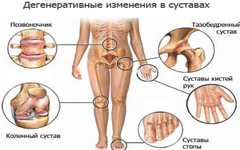 Особенности диеты при артрозе