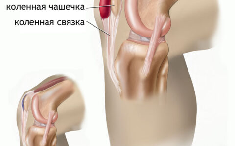 Лечение бурсита народными средствами
