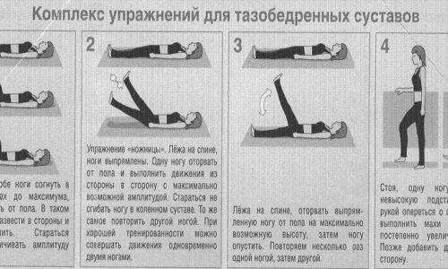 Субхондральный склероз тазобедренного сустава