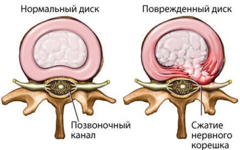 Лечение дорзальной грыжи диска