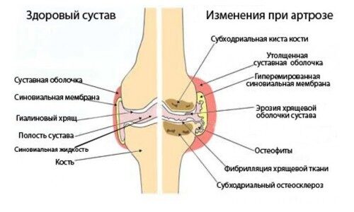 Пиявки при возникшем артрозе коленного сустава