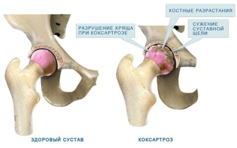 Лечение коксартроза тазобедренного сустава народными средствами