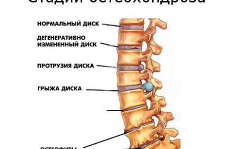 Каким должно быть питание при остеохондрозе