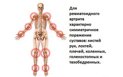 Какой должна быть диета при ревматоидном артрите