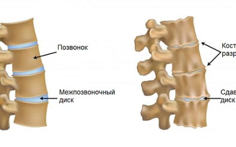 Как лечат артроз позвоночника