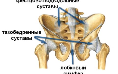 Гигрома тазобедренного сустава