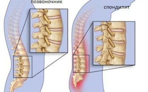 Воспаление позвоночника