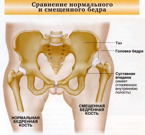 Вывих бедра