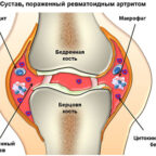 Как определяется инвалидность при ревматоидном артрите?